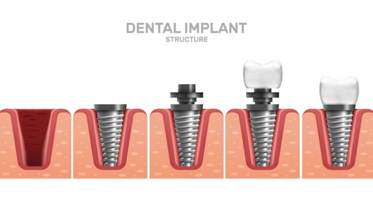 ایمپلنت کامل دندان